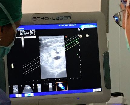 Termoablazione laser: negli ospedali GVM la nuova chirurgia senza bisturi